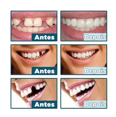 SmileFix Pro | Facetas Dentárias Naturais Removíveis [Últimas Unidades] - Figma Store