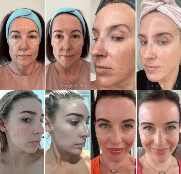 Biocollagen Plus - Máscara de Colágeno com Efeito Botox Instantâneo [40% OFF] - Figma Store